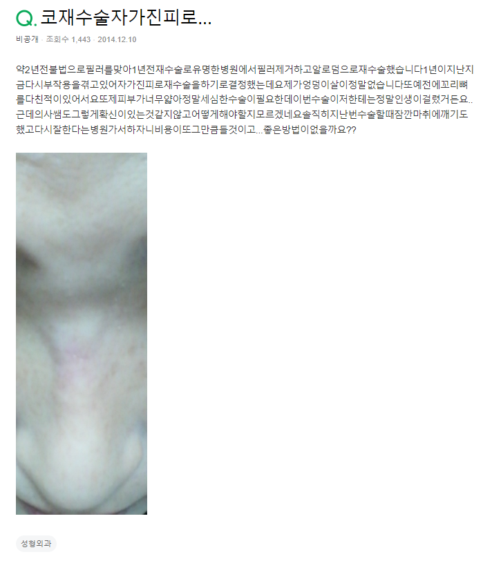 Q. 수술 후 부작용, 자가진피 재수술 괜찮나요?