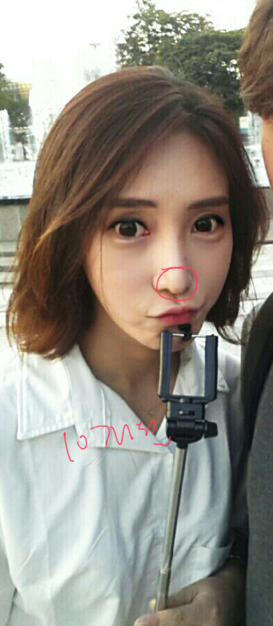 Q. 수술 후 코끝처짐, 개선 방법이 코재수술밖에 없나요? 사진 8
