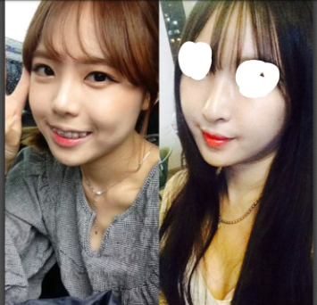 Q. 코끝, 콧대 수술 후 화살코가 된 거 같아요 사진 6