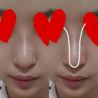 Q. 코끝, 콧대 수술 후 화살코가 된 거 같아요 사진 3