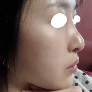 Q. 코끝, 콧대 수술 후 화살코가 된 거 같아요 사진 5