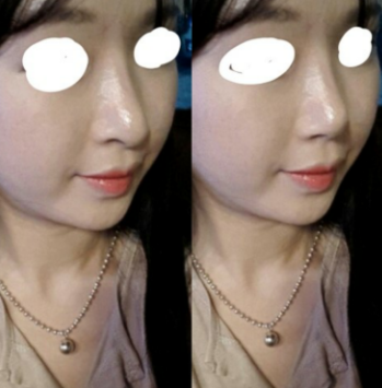 Q. 코끝, 콧대 수술 후 화살코가 된 거 같아요 사진 4