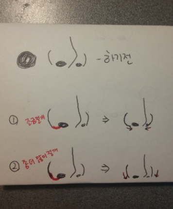 Q. 코절개방법에 따라 콧볼모양이 달라지나요? 사진 3