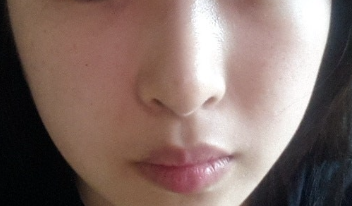 Q. 들린코 수술 후 화살코가 됐습니다. 해결 방법은? 사진 3