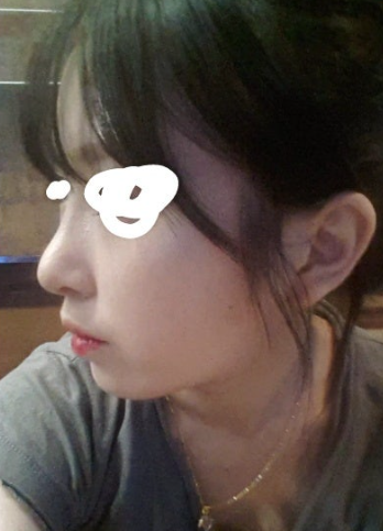 Q. 들린코 수술 후 화살코가 됐습니다. 해결 방법은? 사진 5