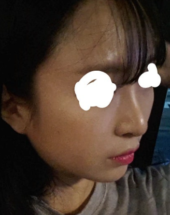 Q. 들린코 수술 후 화살코가 됐습니다. 해결 방법은? 사진 4