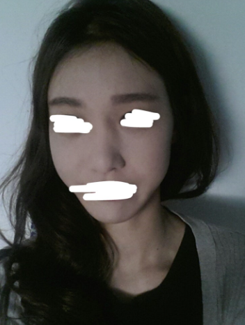 Q. 넓은 콧등뼈 절골술, 얼굴 더 길어 보일까요? 사진 3