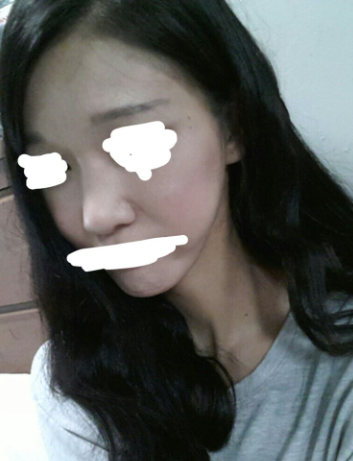 Q. 넓은 콧등뼈 절골술, 얼굴 더 길어 보일까요? 사진 4