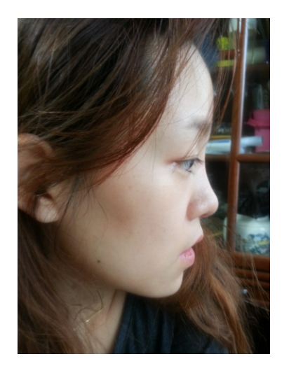 Q. 비중격코수술 후 불편한 느낌, 부작용인가요? 사진 3
