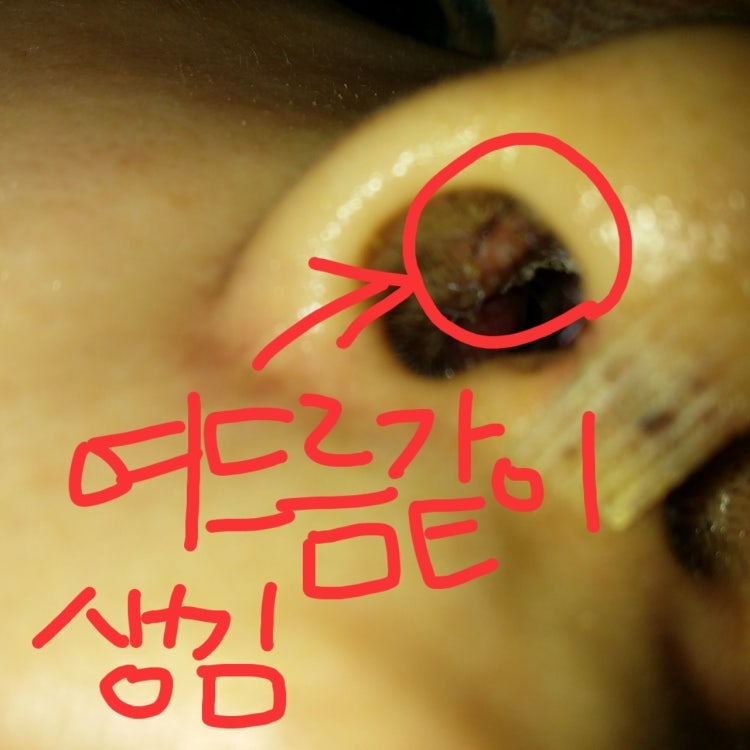 Q. 코안 여드름, 코성형 염증이면 코수술항생제 처방받아야 하나요? 사진 3