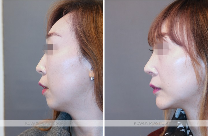 Q. 귀족수술 보형물 효과, 붓기 기간이 지났는데... 사진 4