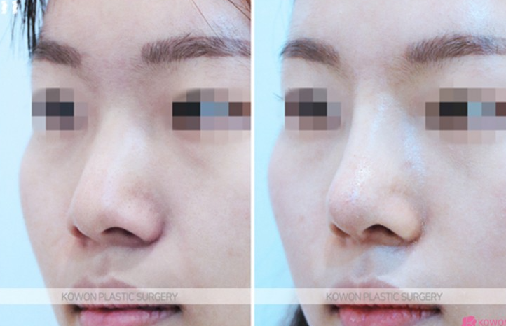 Q. 귀족수술 보형물 효과, 붓기 기간이 지났는데... 사진 5