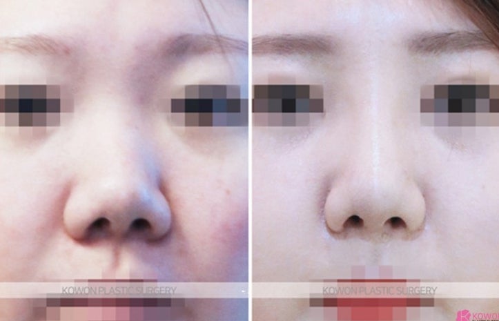 Q. 기증늑연골로 수술했는데 코끝 들림 들창코 같아 보여요. 사진 5