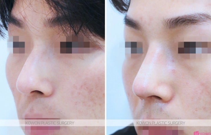 Q. 코 실비보험 들었는데 휘어진 코 기능코성형 적용될까요? 사진 5