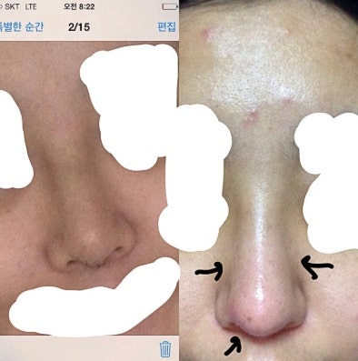 Q. 코성형붓기 콧대 부음, 코수술 염증 때문일까요? 사진 3