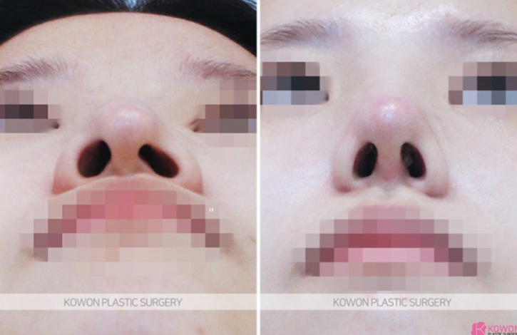 Q. 코수술 후 음주, 코끝 당김이 코염증 증상인가요? 사진 5