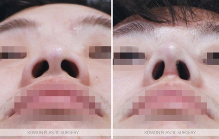 Q. 자가늑코수술 맞춤보형물로 자가조직코성형 하는 게 더 낫나요?