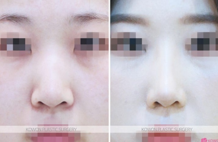 Q. 코끝재수술, 웃을 때 화살코 되는 뭉툭한 코끝은 어떻게 하나요? 사진 8