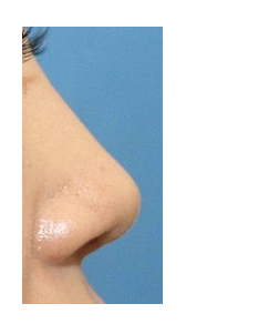 Q. 코끝재수술, 웃을 때 화살코 되는 뭉툭한 코끝은 어떻게 하나요? 사진 5