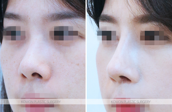 Q. 코성형 주의사항, 코수술 후 안경 쓰고 코 눌림 괜찮을까요?