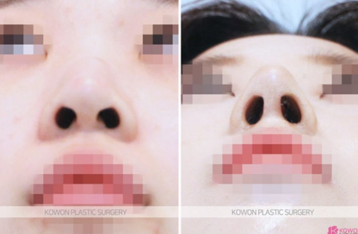 Q. 코성형 주의사항, 코수술 후 안경 쓰고 코 눌림 괜찮을까요? 사진 5