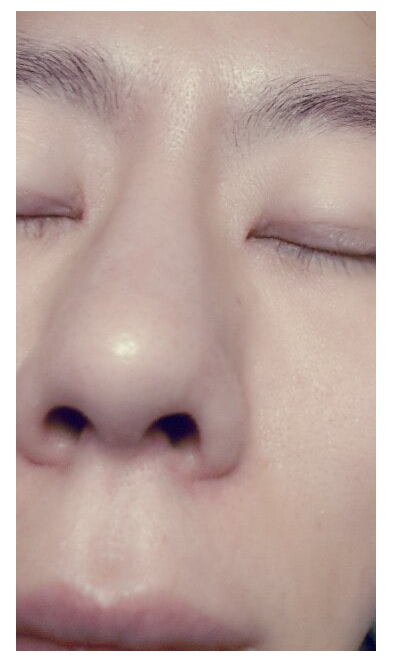 Q. 복코수술붓기 때문에 인위적인 코 같은데 코성형재수술 해야 할까요? 사진 4