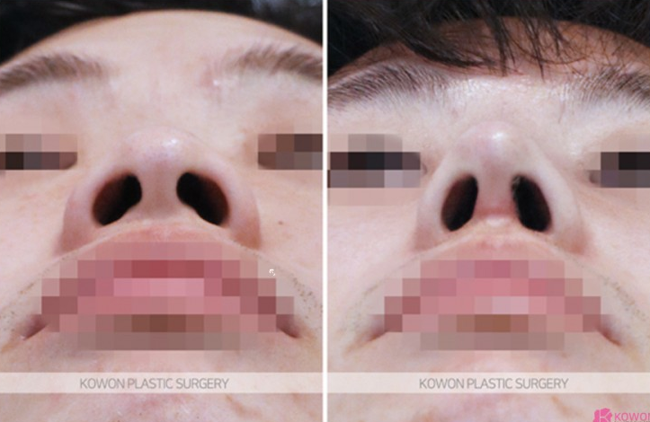 Q. 복코수술붓기 때문에 인위적인 코 같은데 코성형재수술 해야 할까요? 사진 8