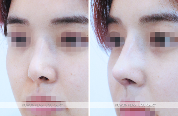 Q. 복코수술붓기 때문에 인위적인 코 같은데 코성형재수술 해야 할까요?