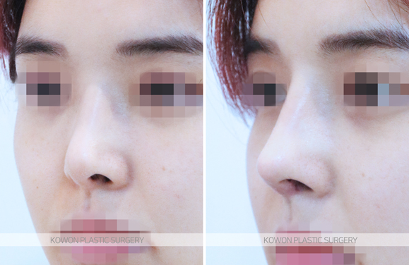 Q. 코재수술성형외과, 코수술 후 부딪힘 때문에 비뚤어진 코 재수술해도 될까? 사진 4