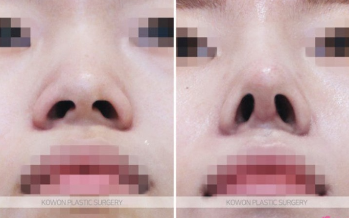Q. 휜코재수술, 코뼈절골 통한 기능코수술 가능할까?