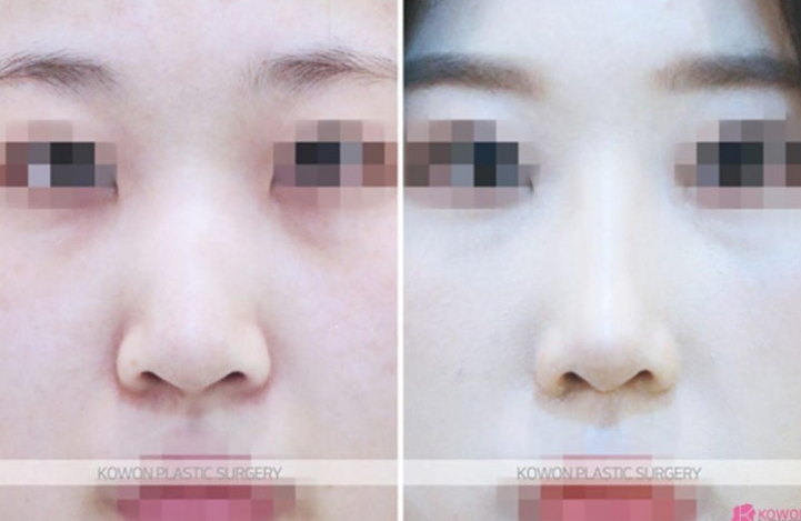 Q. 코수술전필러 래디어스필러 제거 후 수술로 버선코 만들 수 있을까요? 사진 5