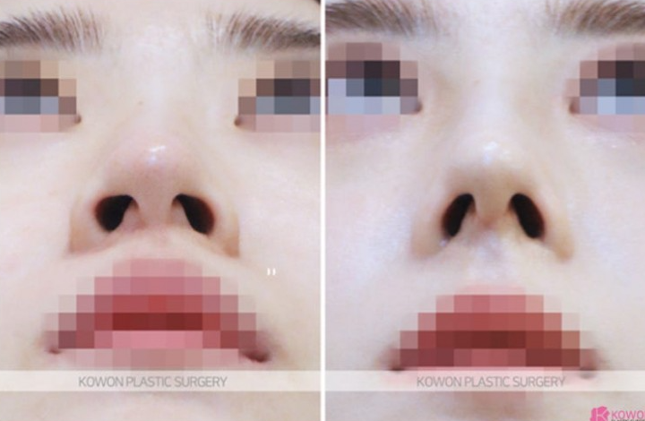 Q. 코끝성형 귀연골코수술 후 건드릴 때 코성형통증 언제 괜찮아지나요? 사진 5