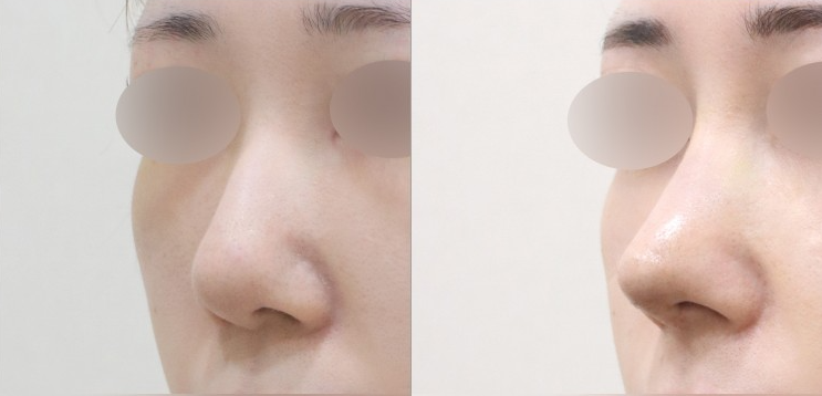 Q. 매부리코 깎고 코수술 통증, 코수술 염증인가요? 사진 3
