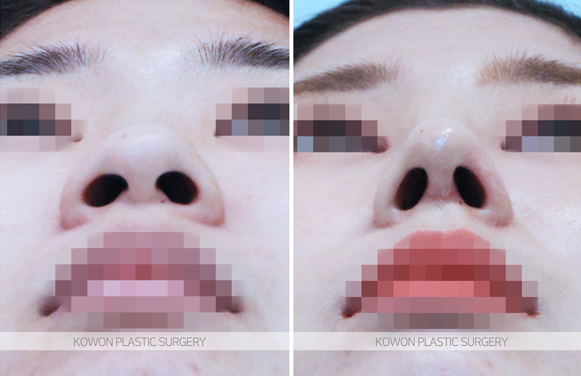 Q. 코뼈 골절 성형, 부러졌는데 휜코교정 콧대올리기 해도 되나요? 사진 3