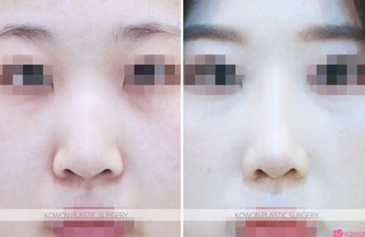 Q. 코뼈 골절 성형, 부러졌는데 휜코교정 콧대올리기 해도 되나요? 사진 4