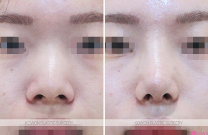 Q. 귀족수술 보형물, 코수술 후 붓기 코통증 불편해요 사진 5