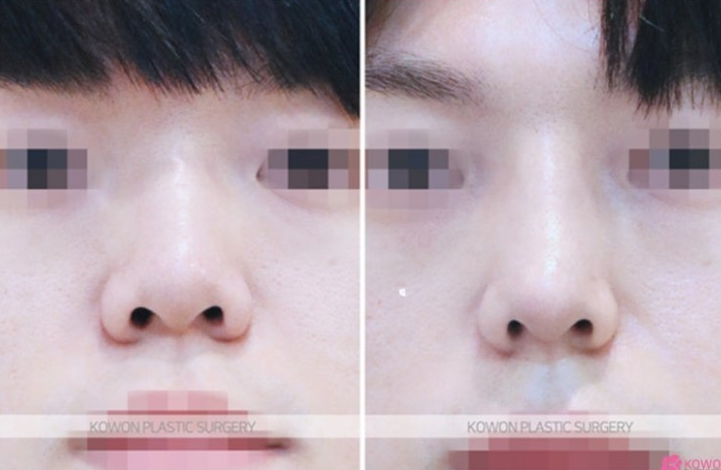 Q. 휜코수술 비대칭 코 컴플렉스, 코성형보험 되나요? 사진 5