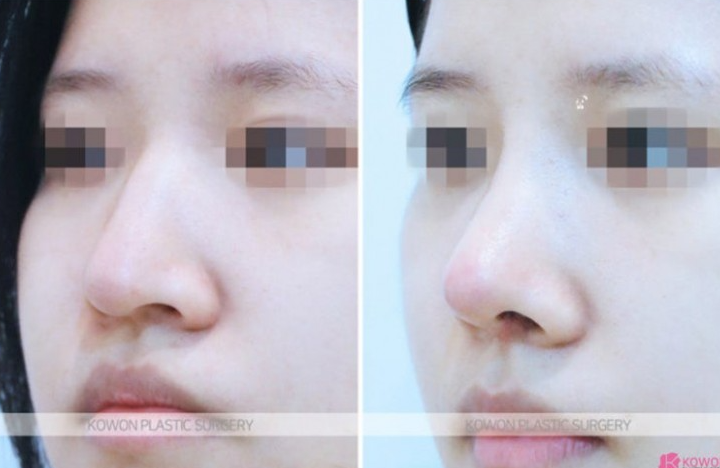 Q. 휜코수술 비대칭 코 컴플렉스, 코성형보험 되나요? 사진 4
