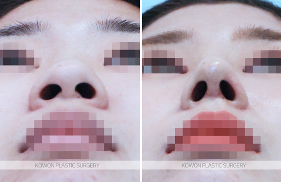 Q. 코성형통증, 코 여드름 짜서 보형물 이동한 걸까요?
