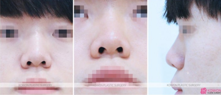 Q. 남자 매부리코수술 어떤 수술 방식이 좋을까요? 사진 3