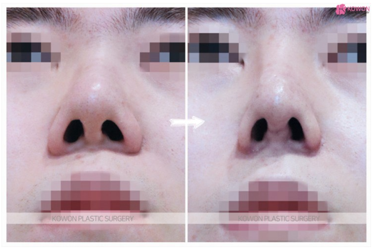 Q. 코 재수술시 일자코로 만들면서 코필러성형도 할수있나요? 사진 5