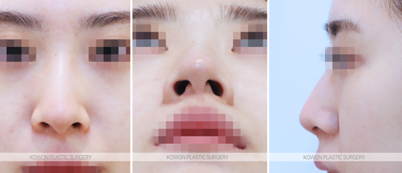 Q. 코지방분해주사로 효과 있을까요? 복코성형이나 코끝수술이 필요한지 궁금합니다 사진 3