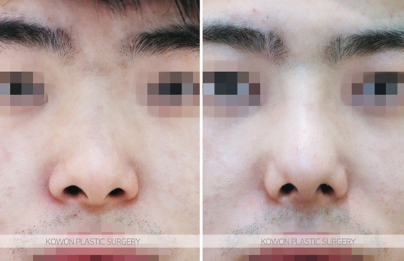 Q. 비중격만곡증 수술 경험 후 복코 관련해서 남자코성형 고민입니다. 사진 4