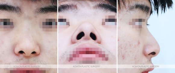 Q. 비중격만곡증 수술 경험 후 복코 관련해서 남자코성형 고민입니다. 사진 3