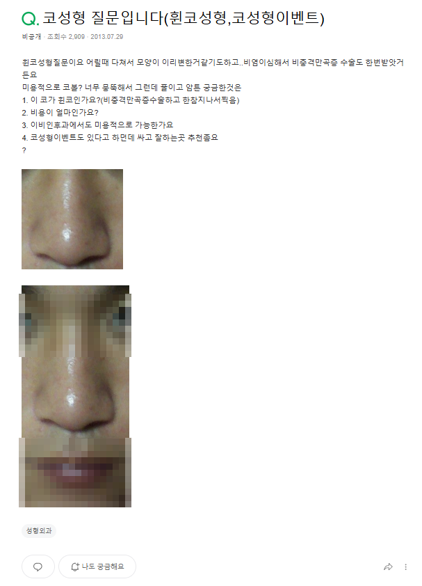 Q. 비중격만곡증 수술 경험 후 복코 관련해서 남자코성형 고민입니다. 사진 2