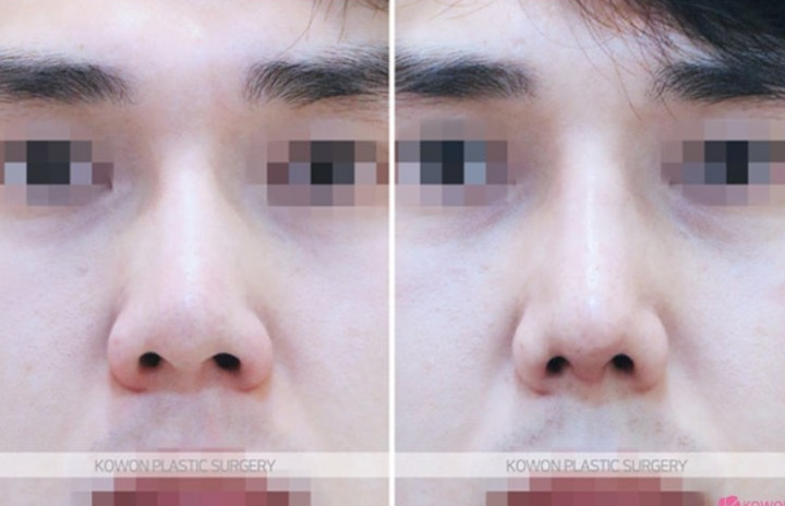Q. 코수술 재수술 코재건수술이 필요한 경우와 코재수술유명한곳 선택 팁 사진 10