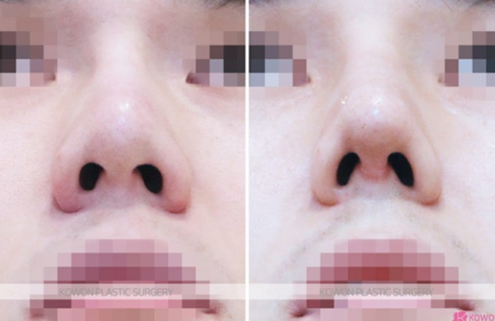 Q. 코수술 재수술 코재건수술이 필요한 경우와 코재수술유명한곳 선택 팁 사진 9