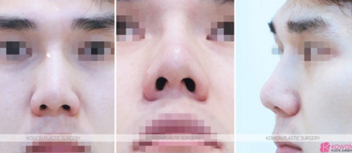 Q. 코수술 재수술 코재건수술이 필요한 경우와 코재수술유명한곳 선택 팁 사진 5