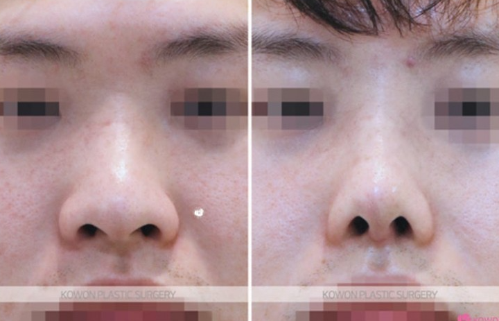 Q. 남자눈코성형 관심있는데 남자 코 성형 외과 어디가 좋을까요? 사진 9
