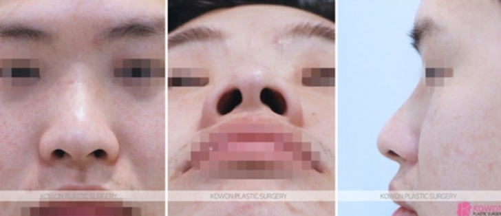 Q. 남자눈코성형 관심있는데 남자 코 성형 외과 어디가 좋을까요? 사진 4